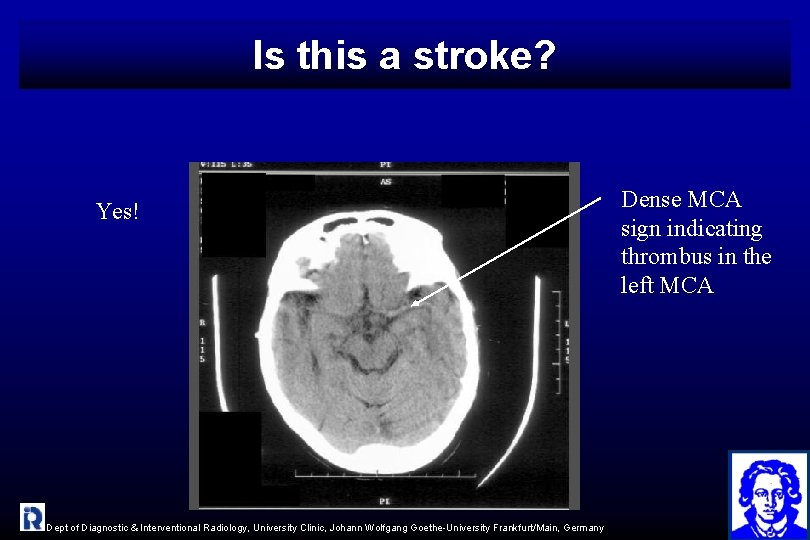 Is this a stroke? Yes! Dept of Diagnostic & Interventional Radiology, University Clinic, Johann