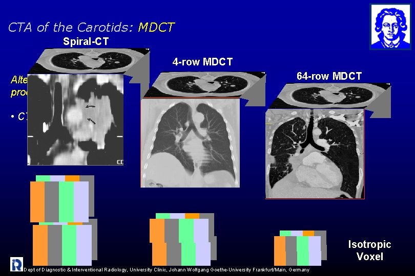 CTA of the Carotids: MDCT Spiral-CT 4 -row MDCT Alternative non-invasive procedures: 64 -row