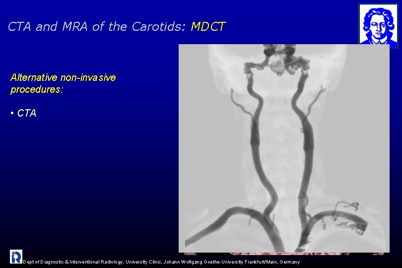 CTA and MRA of the Carotids: MDCT Alternative non-invasive procedures: • CTA Dept of