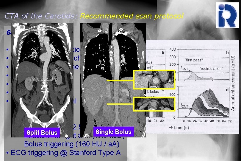 CTA of the Carotids: Recommended scan protocol 64 -slice MDCT • 64 x 0.