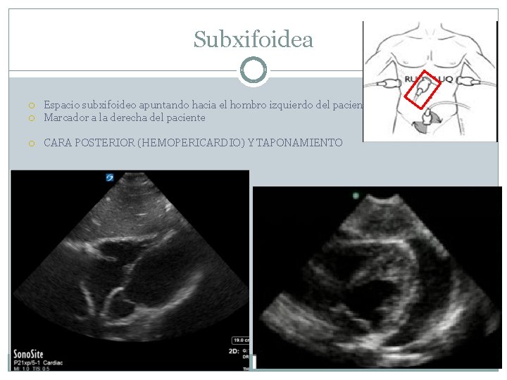Subxifoidea Espacio subxifoideo apuntando hacia el hombro izquierdo del paciente Marcador a la derecha