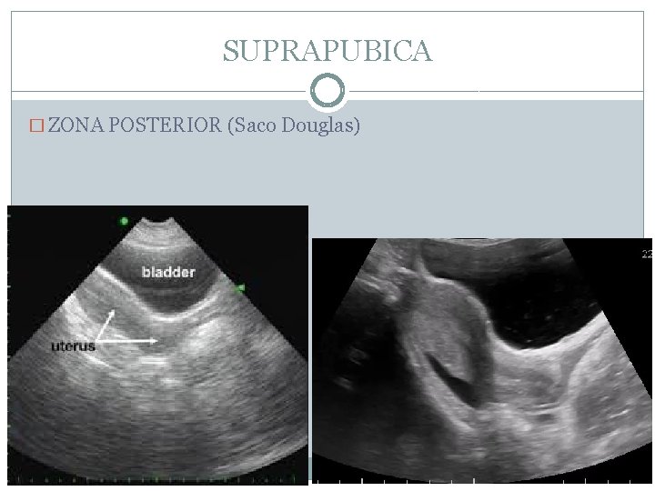 SUPRAPUBICA � ZONA POSTERIOR (Saco Douglas) 