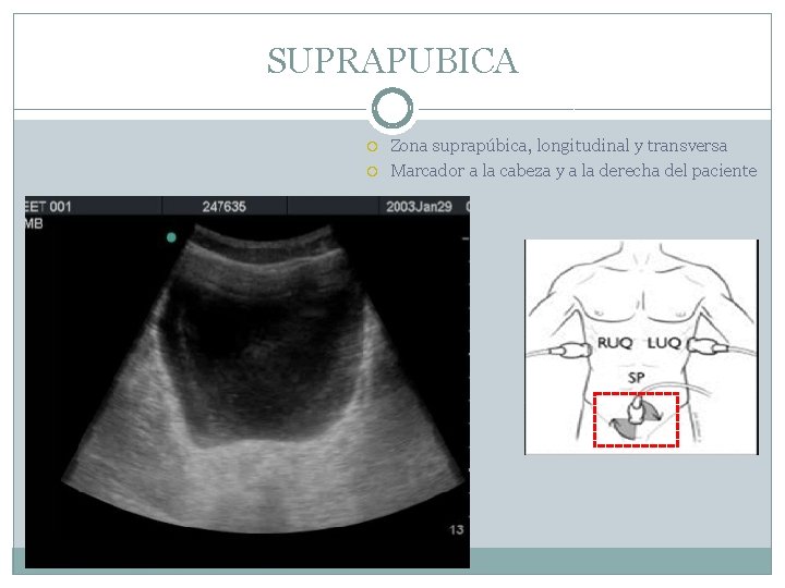 SUPRAPUBICA Zona suprapúbica, longitudinal y transversa Marcador a la cabeza y a la derecha
