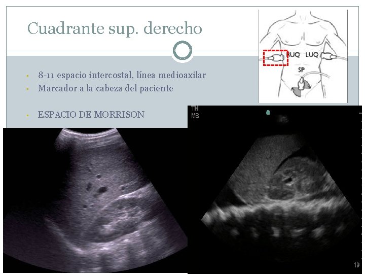 Cuadrante sup. derecho • 8 -11 espacio intercostal, línea medioaxilar Marcador a la cabeza