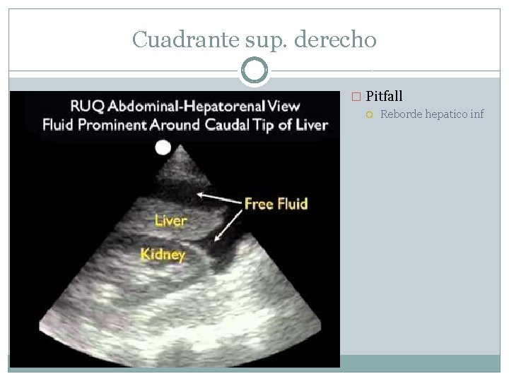 Cuadrante sup. derecho � Pitfall Reborde hepatico inf 