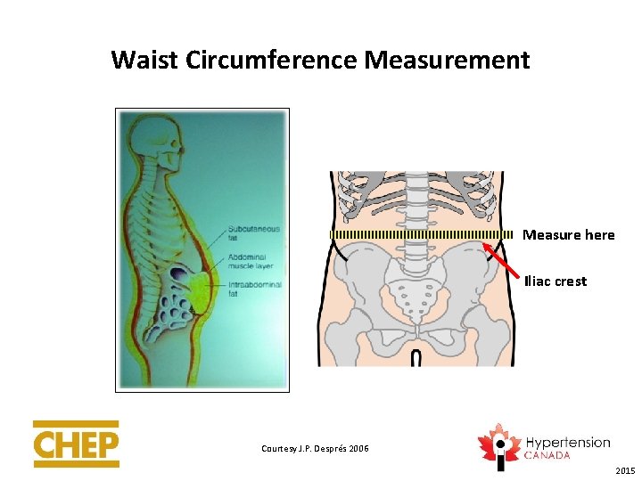 Waist Circumference Measurement Measure here Iliac crest Courtesy J. P. Després 2006 2015 