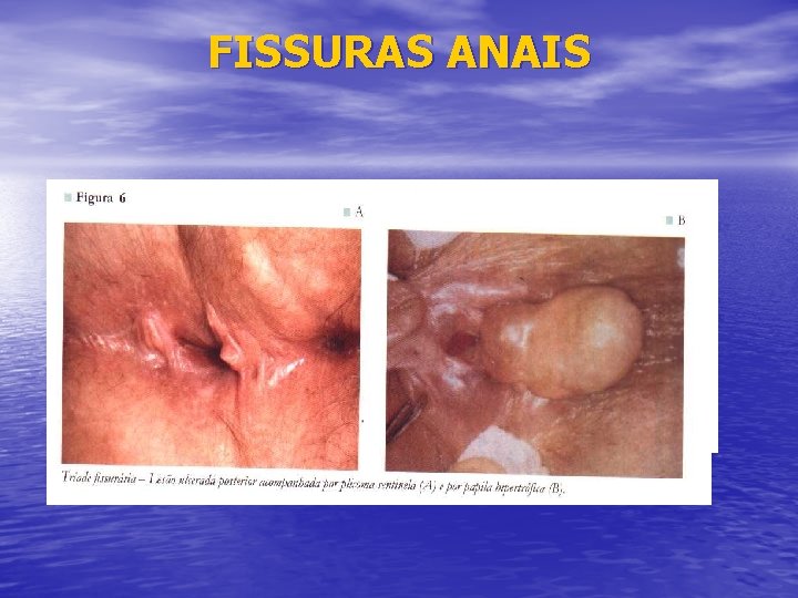 FISSURAS ANAIS 