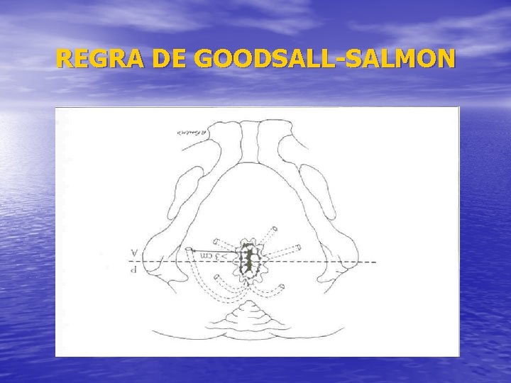 REGRA DE GOODSALL-SALMON 
