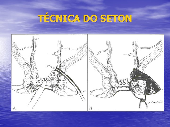 TÉCNICA DO SETON 