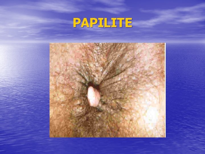 PAPILITE 