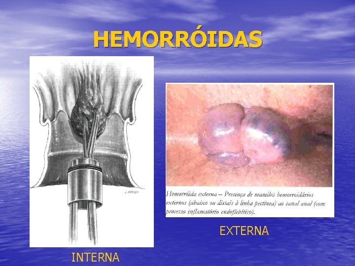 HEMORRÓIDAS EXTERNA INTERNA 