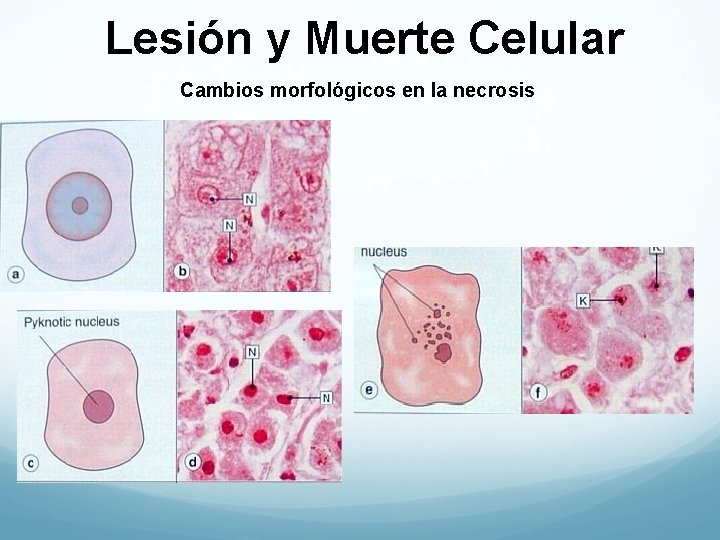 Lesión y Muerte Celular Cambios morfológicos en la necrosis 