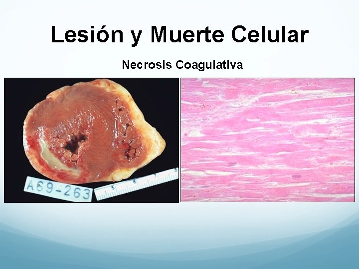 Lesión y Muerte Celular Necrosis Coagulativa 