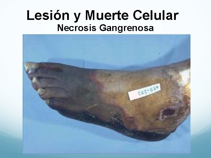 Lesión y Muerte Celular Necrosis Gangrenosa 
