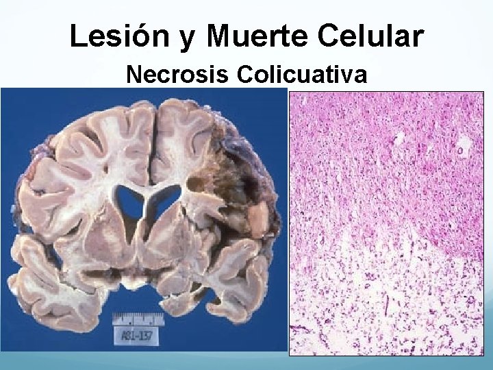 Lesión y Muerte Celular Necrosis Colicuativa 