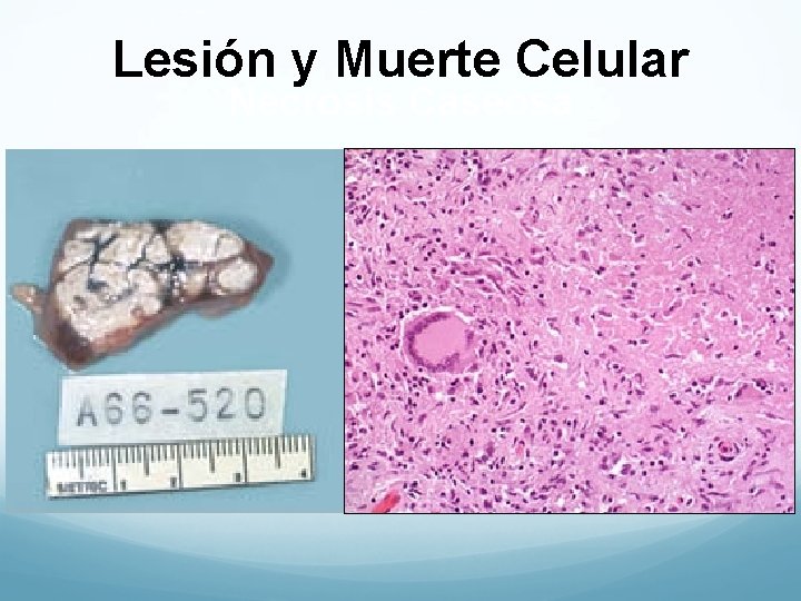 Lesión y Muerte Celular Necrosis Caseosa 