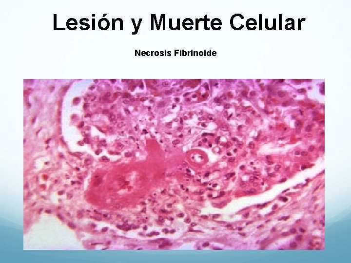 Lesión y Muerte Celular Necrosis Fibrinoide 