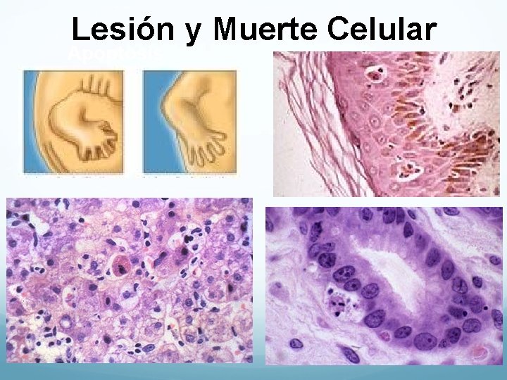 Lesión y Muerte Celular Apoptosis 