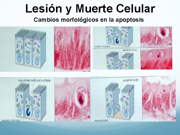 Lesión y Muerte Celular Cambios morfológicos en la apoptosis 