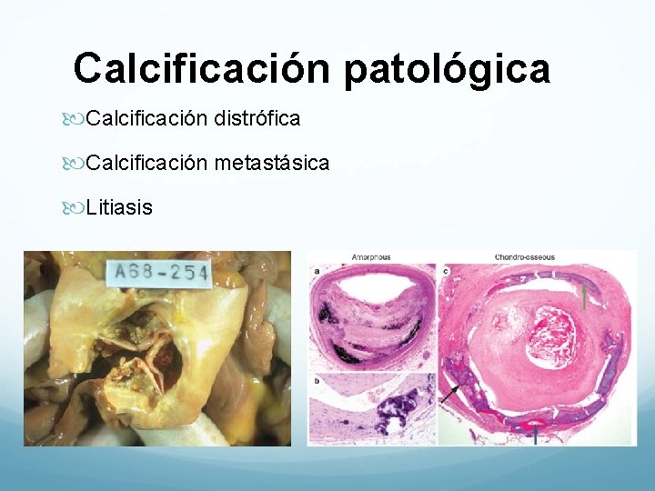 Calcificación patológica Calcificación distrófica Calcificación metastásica Litiasis 