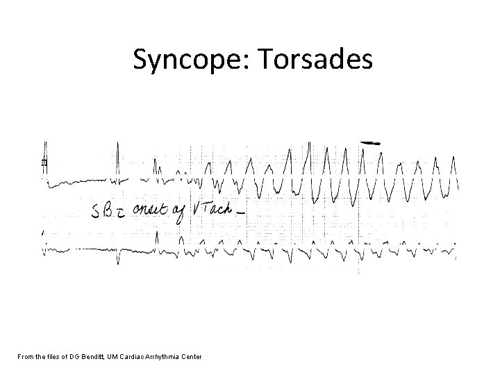 Syncope: Torsades From the files of DG Benditt, UM Cardiac Arrhythmia Center 