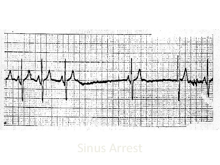 Sinus Arrest 