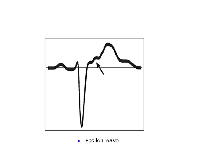 n Epsilon wave 