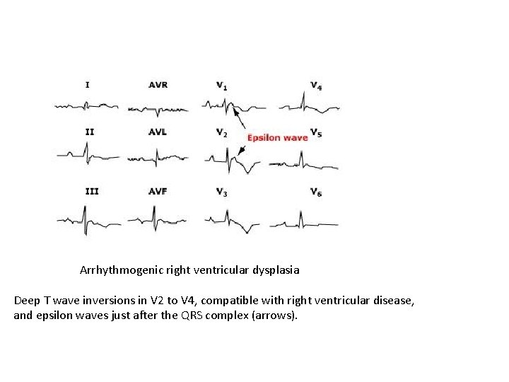 Arrhythmogenic right ventricular dysplasia Deep T wave inversions in V 2 to V 4,