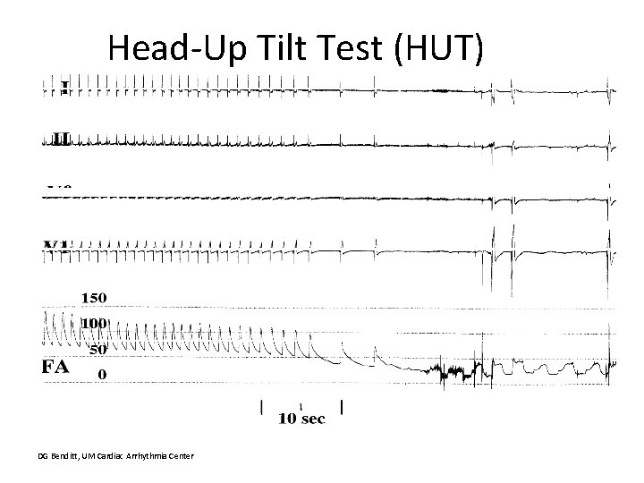 Head-Up Tilt Test (HUT) DG Benditt, UM Cardiac Arrhythmia Center 