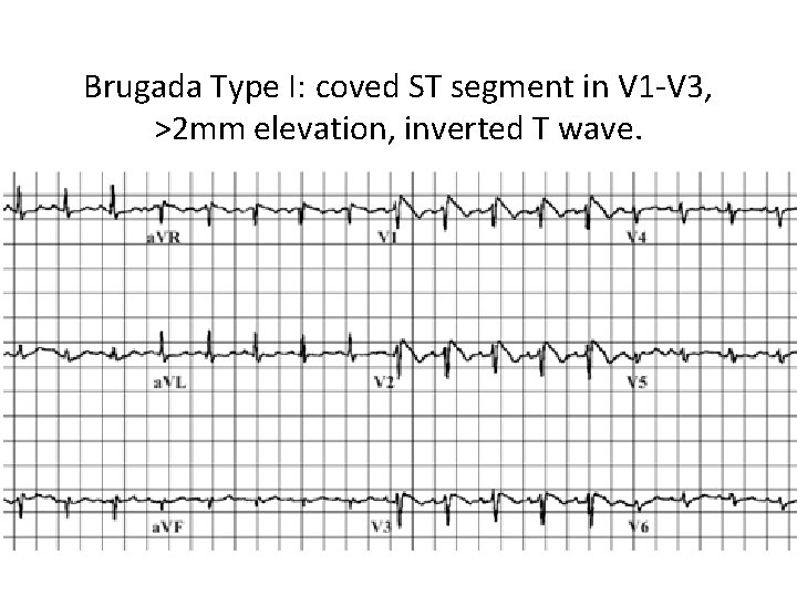 Brugada Type I: coved ST segment in V 1 -V 3, >2 mm elevation,