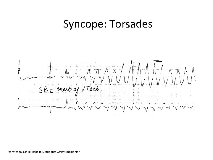 Syncope: Torsades From the files of DG Benditt, UM Cardiac Arrhythmia Center 