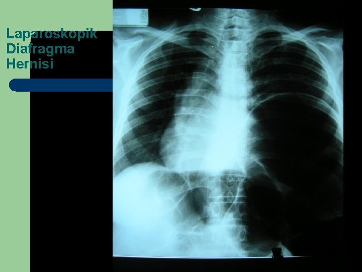 Laparoskopik Diafragma Hernisi 