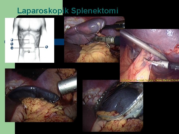 Laparoskopik Splenektomi 