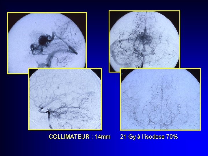 COLLIMATEUR : 14 mm 21 Gy à l’isodose 70% 