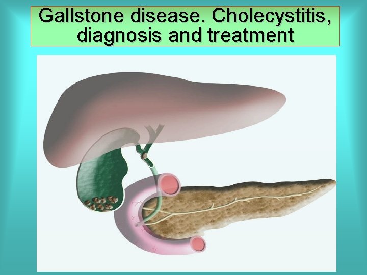 Gallstone disease. Cholecystitis, diagnosis and treatment 