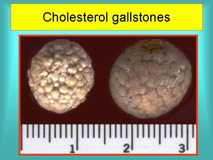 Cholesterol gallstones 
