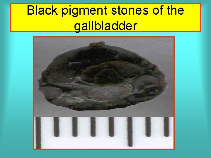Black pigment stones of the gallbladder 