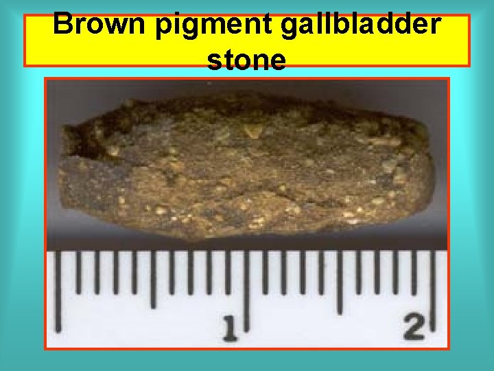Brown pigment gallbladder stone 