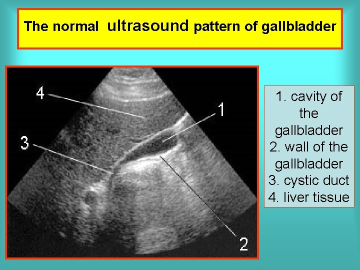 The normal ultrasound pattern of gallbladder 1. cavity of the gallbladder 2. wall of