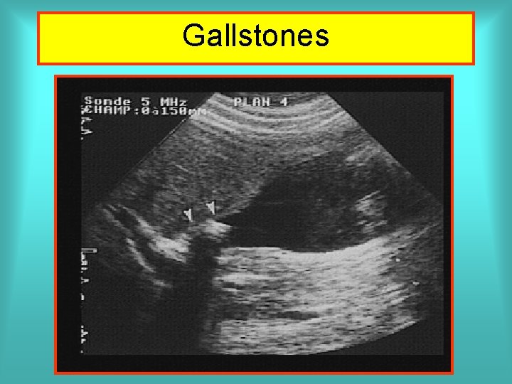 Gallstones 