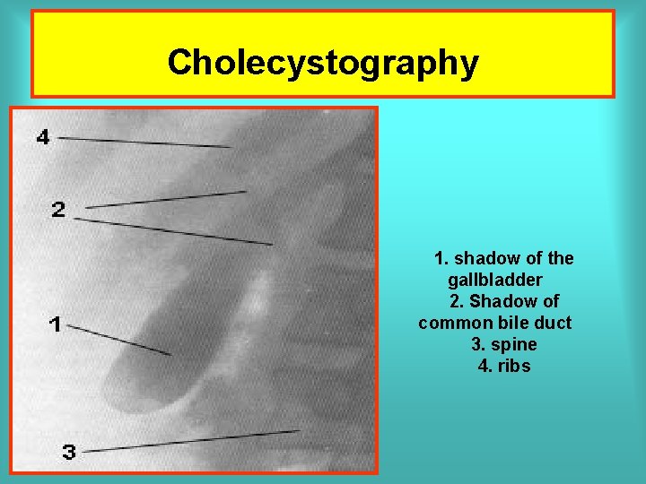 Cholecystography 1. shadow of the gallbladder 2. Shadow of common bile duct 3. spine