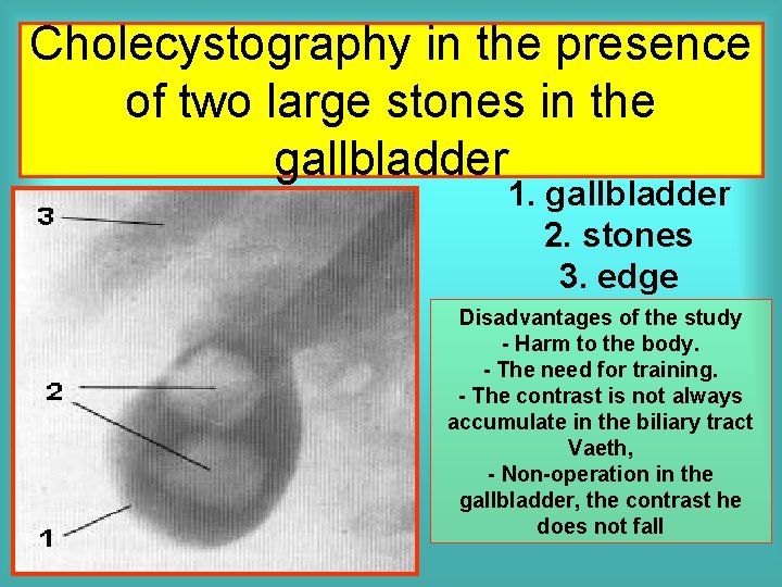 Cholecystography in the presence of two large stones in the gallbladder 1. gallbladder 2.