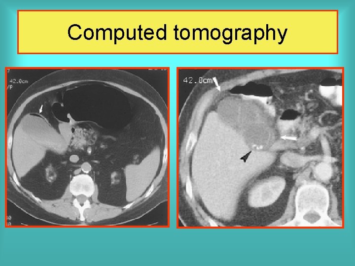 Computed tomography 