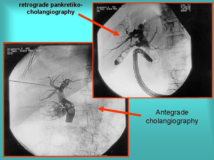 retrograde pankretikocholangiography Antegrade cholangiography 