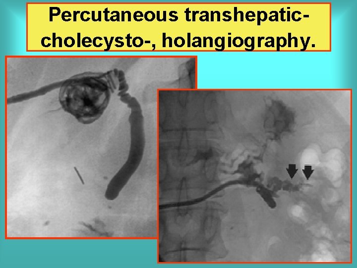 Percutaneous transhepaticcholecysto-, holangiography. 