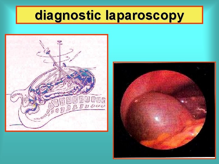 diagnostic laparoscopy 