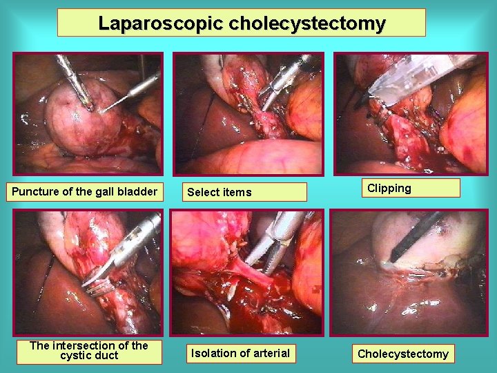 Laparoscopic cholecystectomy Puncture of the gall bladder The intersection of the cystic duct Select