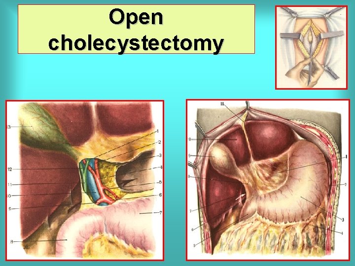 Open cholecystectomy 