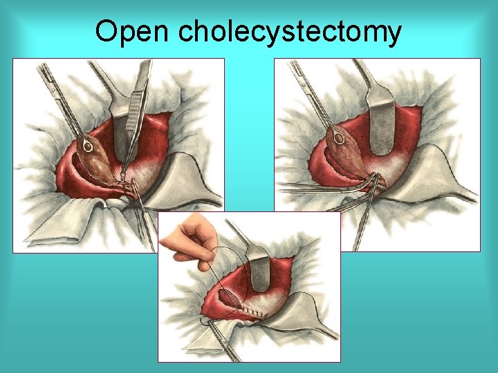 Open cholecystectomy 