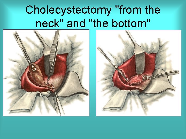 Cholecystectomy "from the neck" and "the bottom" 